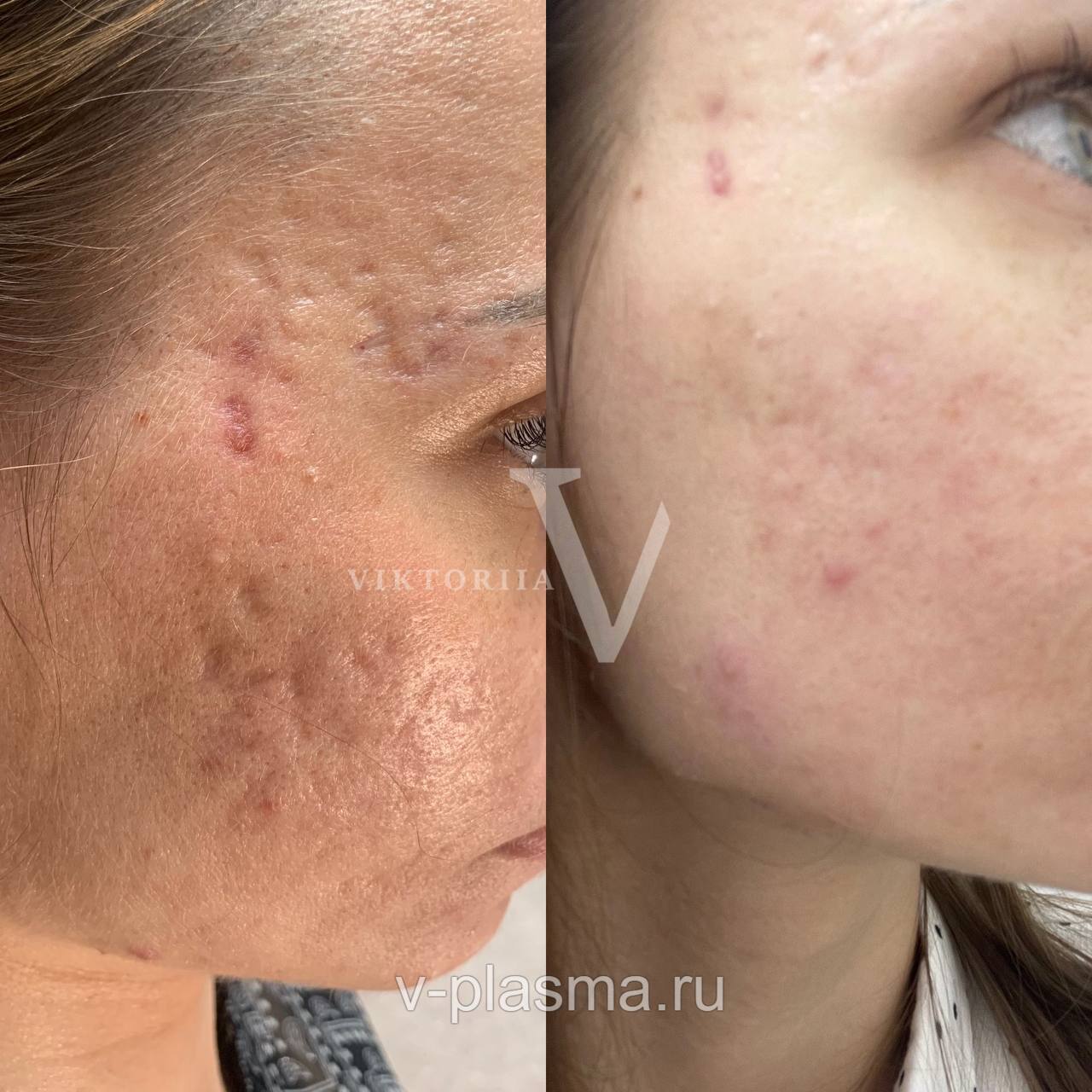 Акне, постакне - 2 процедуры