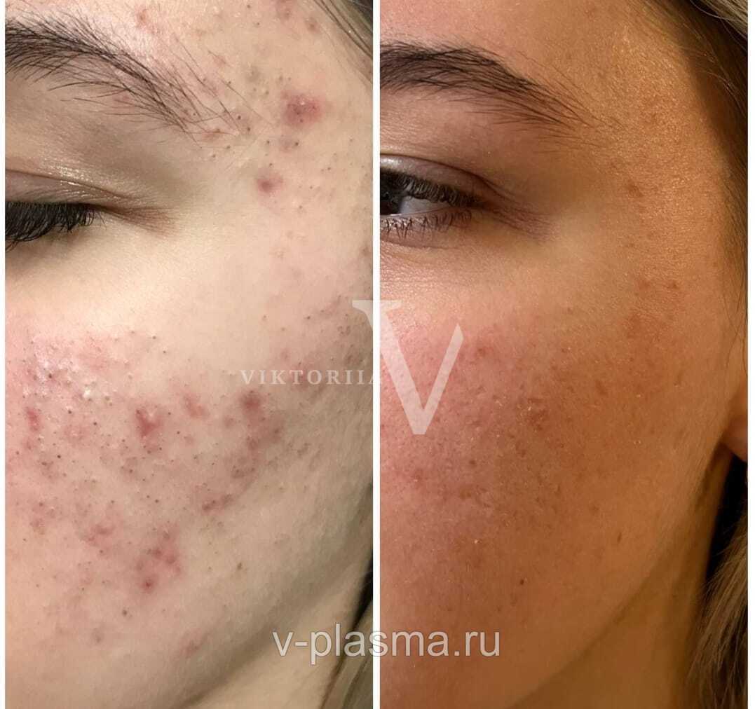 Акне. Чистка. Холодная плазма. 1 процедура.