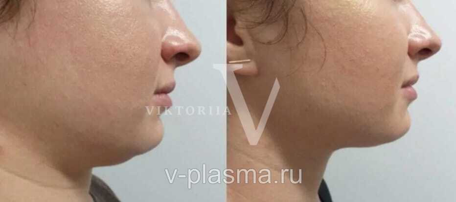 Коррекция подбородка. Холодная плазма. 2 процедуры