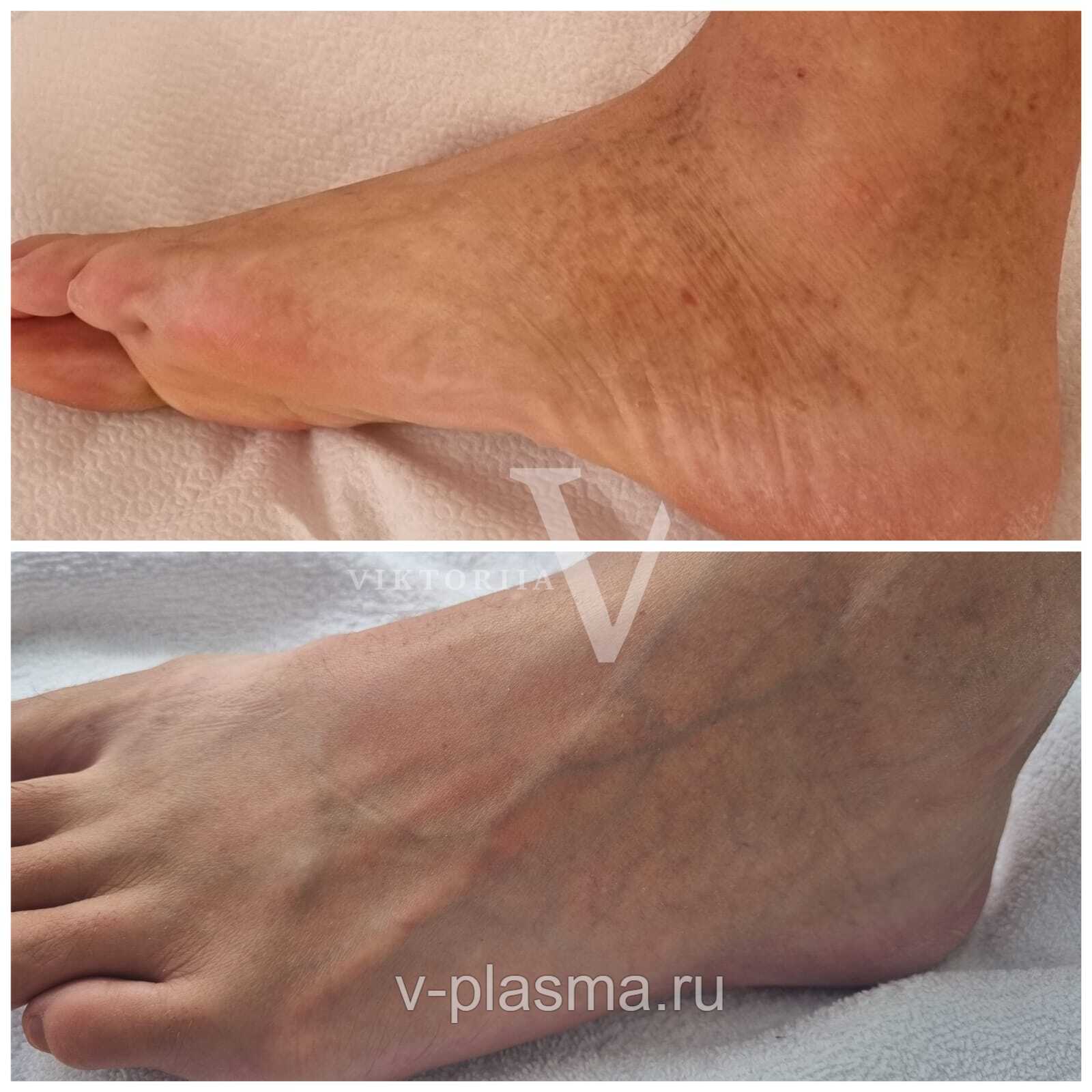 Дермотоз. Холодная плазма. 2 процедуры